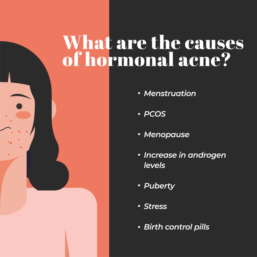 Hormonal acne causes and solutions

